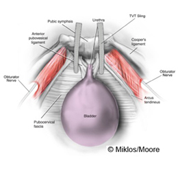 Normal TVT Sling