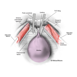 TVT Sling Erosion into Urethra