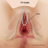 Mesh erosion in urethra / bladder