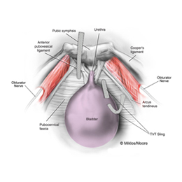 TVT Portion removed to release tension