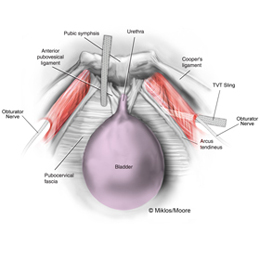 TVT Portion removed to release tension