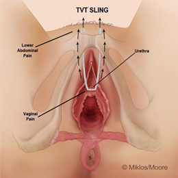 Outward tension causing Vaginal Pain