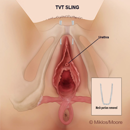 TVT Portion removed to release tension